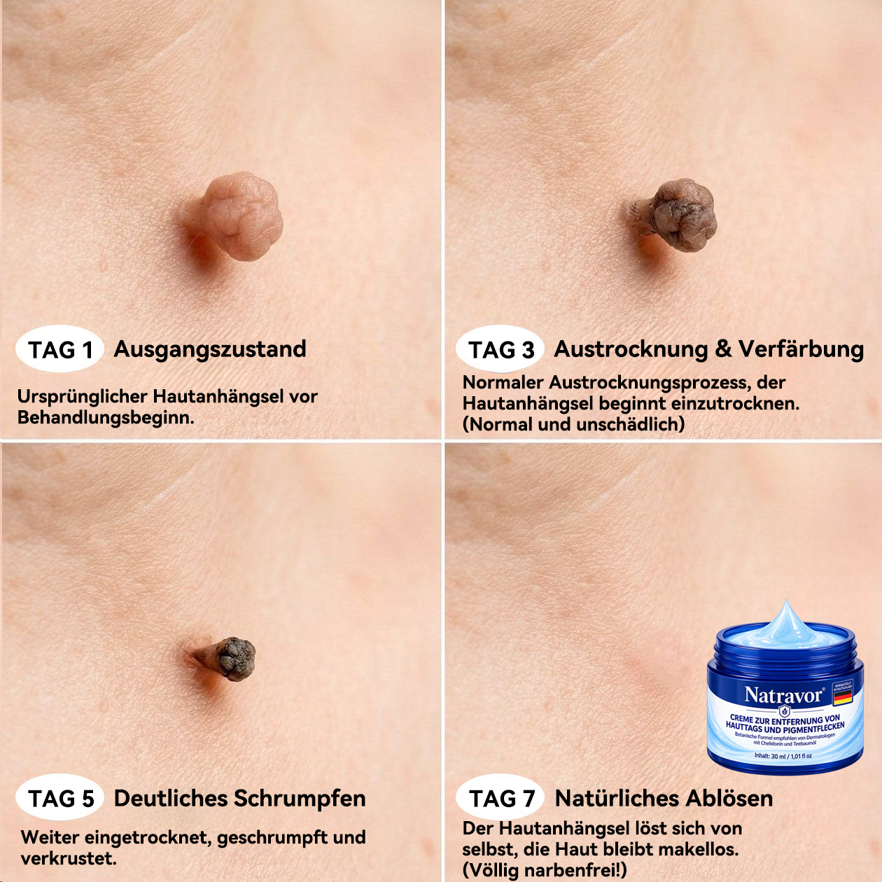 Natravor® 𝟕-𝐓𝐚𝐠𝐞 𝐇𝐚𝐮𝐭𝐚𝐧𝐡ä𝐧𝐠𝐬𝐞𝐥- & 𝐅𝐥𝐞𝐜𝐤𝐞𝐧-𝐄𝐧𝐭𝐟𝐞𝐫𝐧𝐮𝐧𝐠𝐬𝐜𝐫𝐞𝐦𝐞 (𝐒𝐜𝐡𝐦𝐞𝐫𝐳𝐟𝐫𝐞𝐢𝐞 𝐅𝐨𝐫𝐦𝐞𝐥 – 𝐨𝐡𝐧𝐞 𝐍𝐚𝐫𝐛𝐞𝐧) 🎉